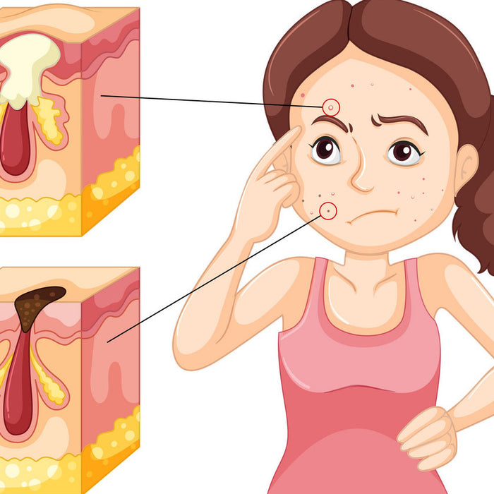 Toothpaste For Pimples And Acne Spot Treatment?