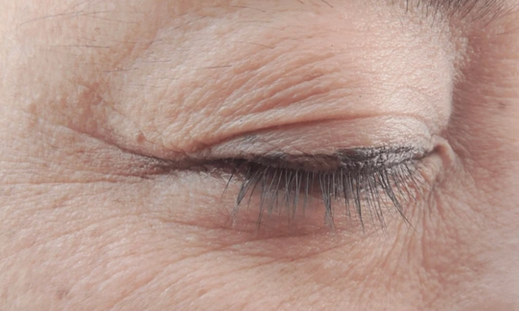 eyelids irritation