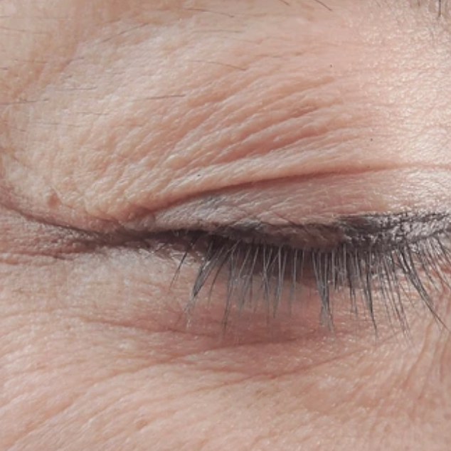 eyelids irritation