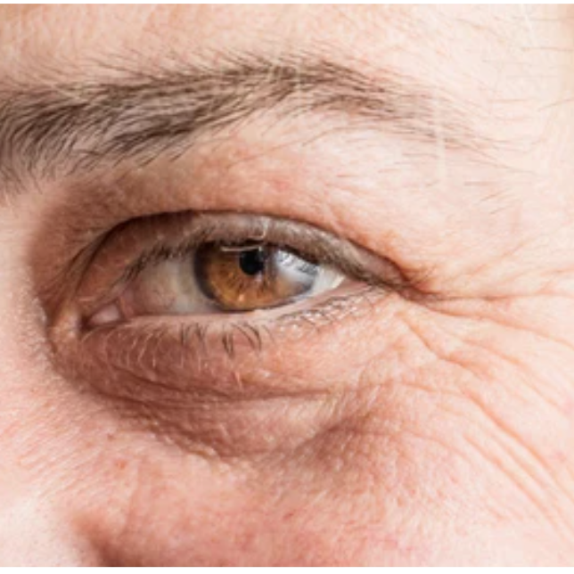 How to Get Rid of Dark Circles Under the Eyes: Causes, Treatments, and Skincare Solutions