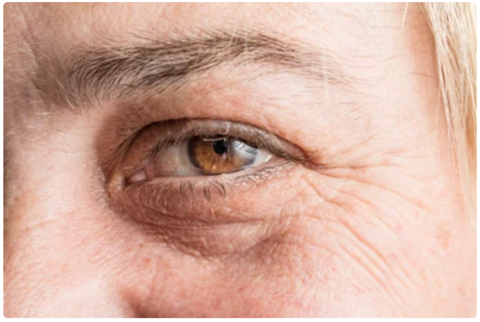 How to Get Rid of Dark Circles Under the Eyes: Causes, Treatments, and Skincare Solutions