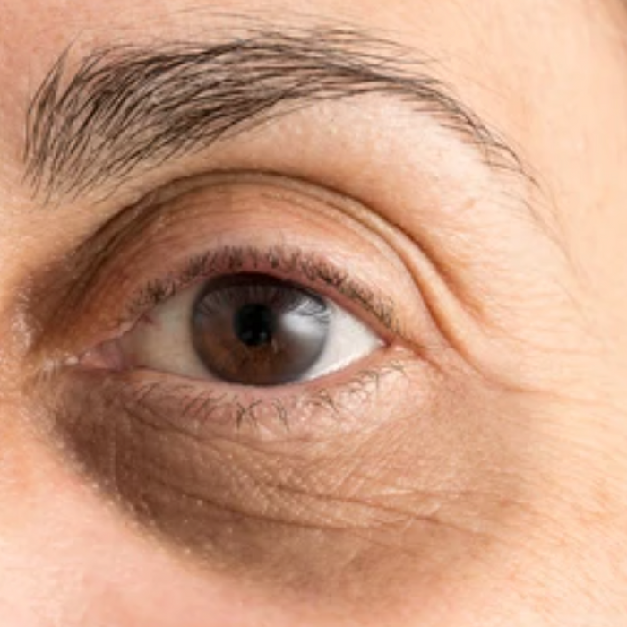 What Causes Dark Circles Under the Eyes? Causes, Treatments, and Prevention