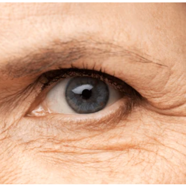 fine lines and wrinkles around the eyes 