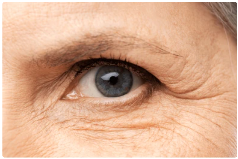 fine lines and wrinkles around the eyes 