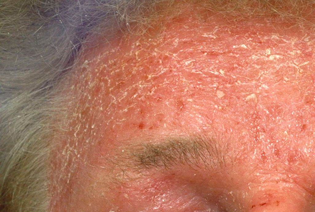 Sunscreen, UV Damage, and the Skin Barrier