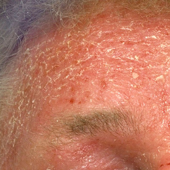 Sunscreen, UV Damage, and the Skin Barrier