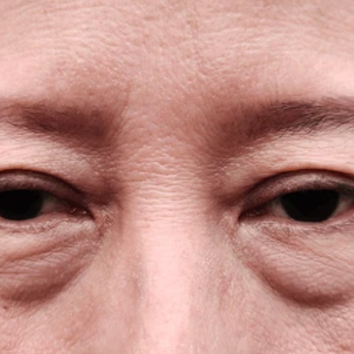 eye puffiness, eye bags, dark circles 