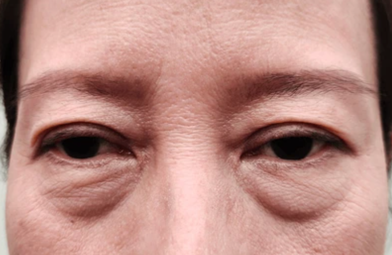 eye puffiness, eye bags, dark circles 