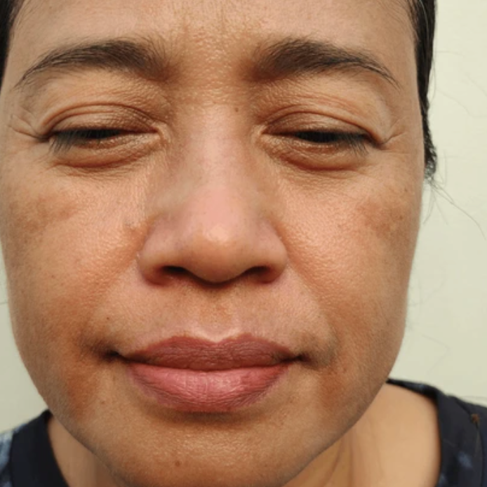 Why are my eyelids itchy and irritated?