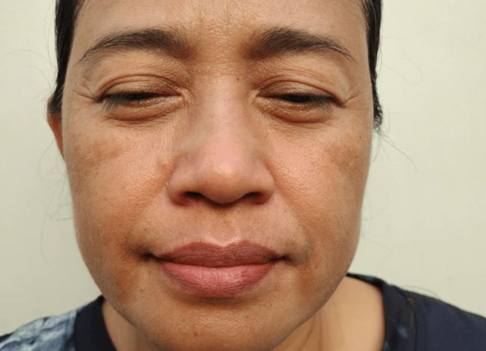 Why are my eyelids itchy and irritated?