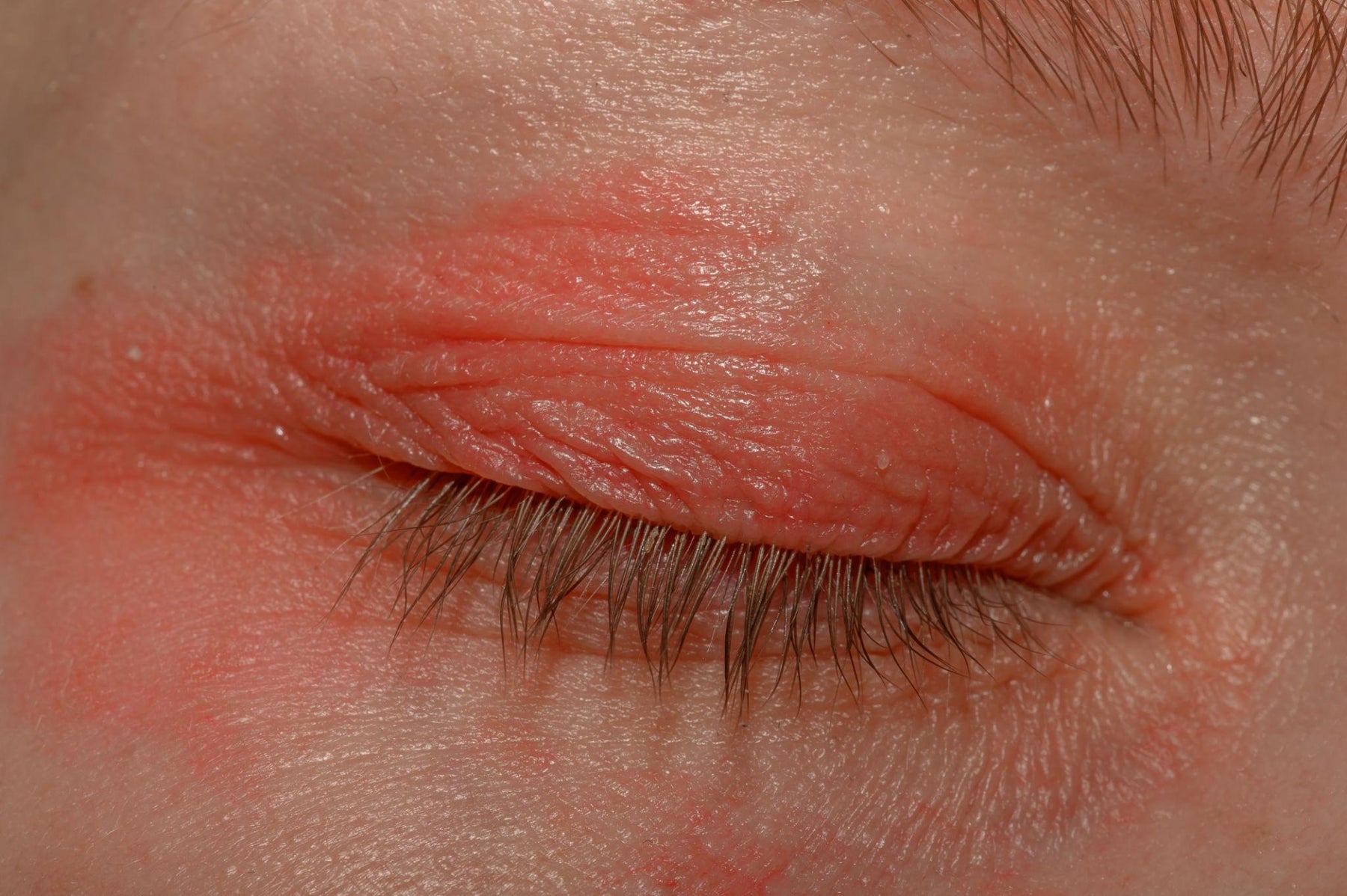 How to Know If Your Eyelid Skin Barrier Is Damaged