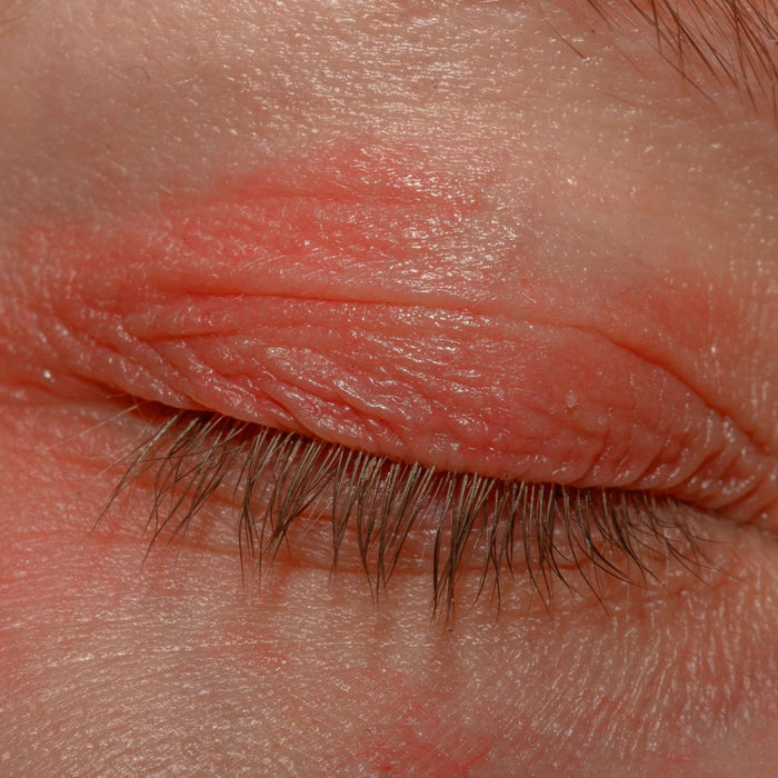 How to Know If Your Eyelid Skin Barrier Is Damaged